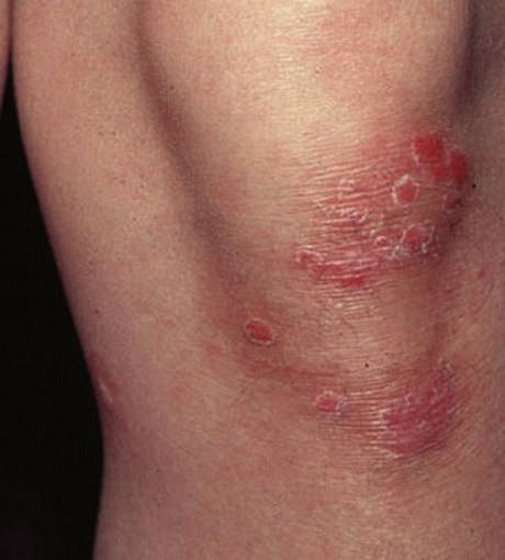 Хламидийный артрит: симптомы, причины и лечение