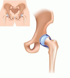 A csípőízület csontritkulásának (DOA) deformálása 2 fok: mi az és hogyan kell kezelni