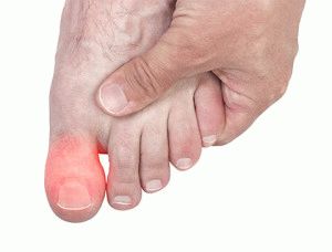 lábujj zsibbadás a lábak ízületeinek másodlagos ízületi gyulladása