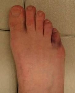 A törött lábujj észlelése: a sérülés fő jelei és tünetei - Radiculitis 