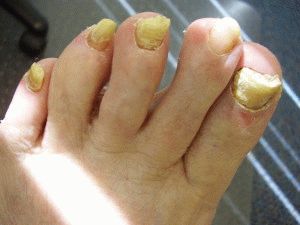 Почему желтеют ногти на больших пальцах ног