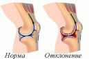 Лечение деформирующего артроза коленного сустава и его степени