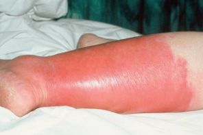 Отёки ног после рожистого воспаления