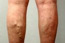 Последствия варикоза на ногах