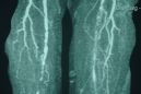 Стенозирующий атеросклероз артерий нижних конечностей