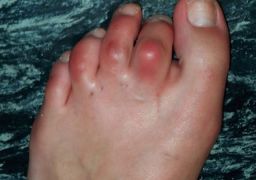 Воспаление сустава большого пальца ноги
