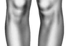 Артрозо-артрит коленного сустава