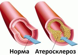 Атеросклероз нижних конечностей в старческом возрасте