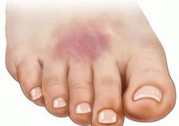 Что делать, если шишка на ноге после удара не проходит