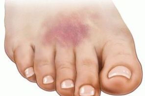 Что делать, если шишка на ноге после удара не проходит