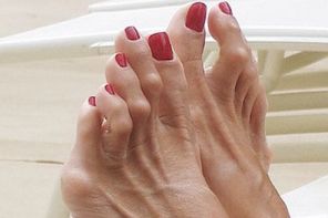 Молоткообразные пальцы ног