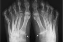Рентгенологические признаки ревматоидного артрита