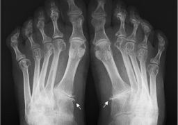 Рентгенологические признаки ревматоидного артрита