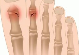 Как определить перелом пальца на ноге