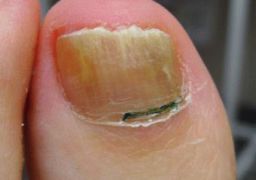 Лечение грибка ногтя на большом пальце ноги