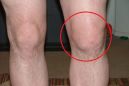 Методы лечения подагры коленного сустава