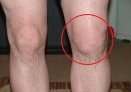 Методы лечения подагры коленного сустава