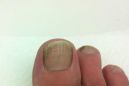 Трещины на ногте большого пальца ноги
