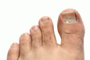 Как лечить грибок ногтей на ногах йодом
