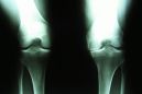 Остеоартроз коленного сустава 3 степени