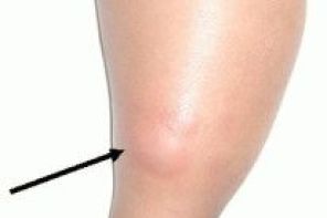 Шишка на икре ноги