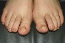 Чем лечить грибок ногтей на ногах