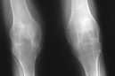 Последствия артрита коленного сустава