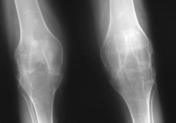 Последствия артрита коленного сустава