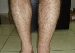 Причины отёков голени