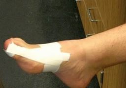 Ушиб ногтя большого пальца ноги
