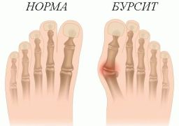 Диагностика и лечение бурсита большого пальца стопы