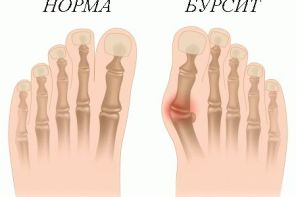 Диагностика и лечение бурсита большого пальца стопы