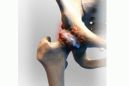 Реактивный артрит тазобедренного сустава у детей
