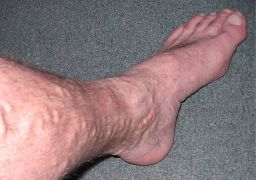 Как лечить варикоз на ногах у мужчин