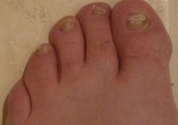 Лечение онихомикоза ногтей на ногах