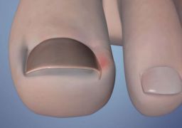 Почему опух палец на ноге возле ногтя