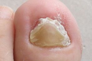 Лечение застарелого грибка ногтей на ногах