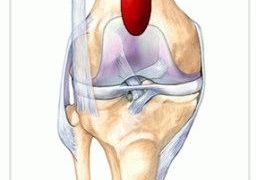 Супрапателлярный бурсит коленного сустава