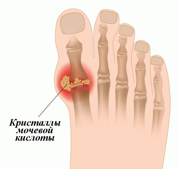 Подагра большого пальца на ноге фото