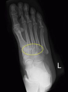 Рентген снимок больной ноги