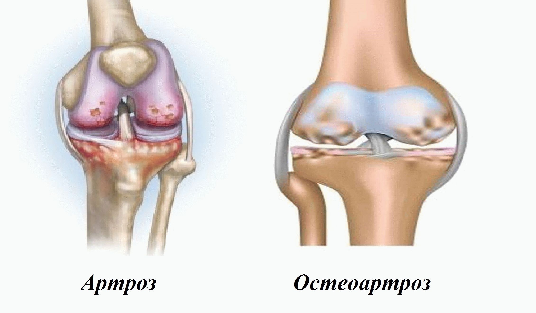 Поражение крупных суставов. Симптомы заболевания остеоартроз. Остеоартрит и остеоартроз. .Деформирующий остеоартрит остеоартроз. Деформирующий артроз (остеоартроз).