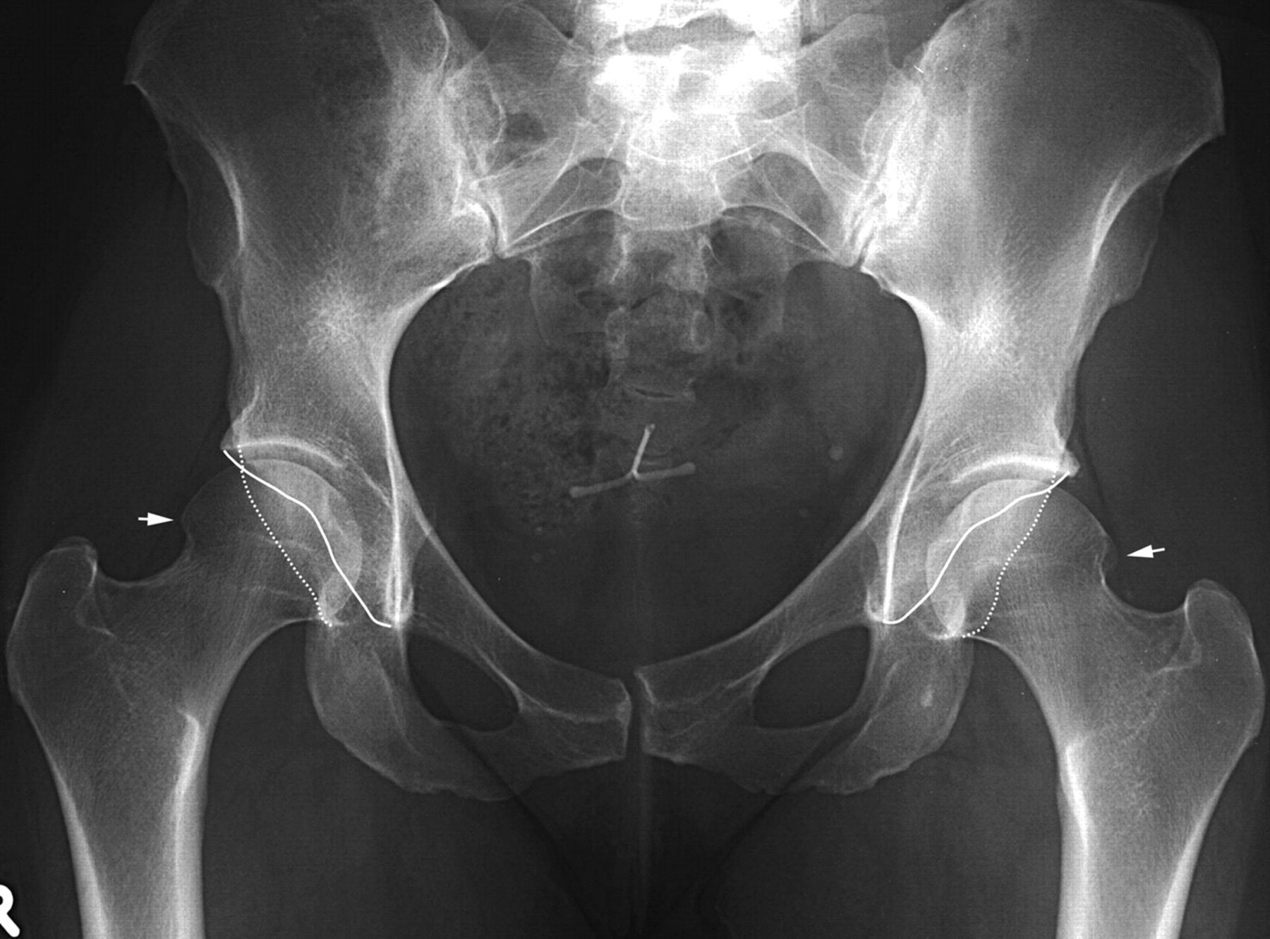 Что такое тбс. Коксартроз тазобедренного сустава рентген. Рентген анатомия тазобедренного сустава коксартроз. Артроз тазобедренного сустава рентген.