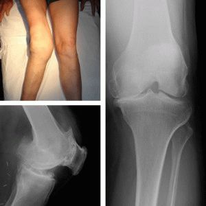 Деформирующий гонартроз коленного сустава 2 степени лечение