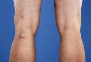 Что такое бурсит коленного сустава
