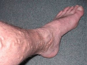 Тромбоз вен ног