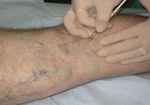Лечение варикоза на ногах