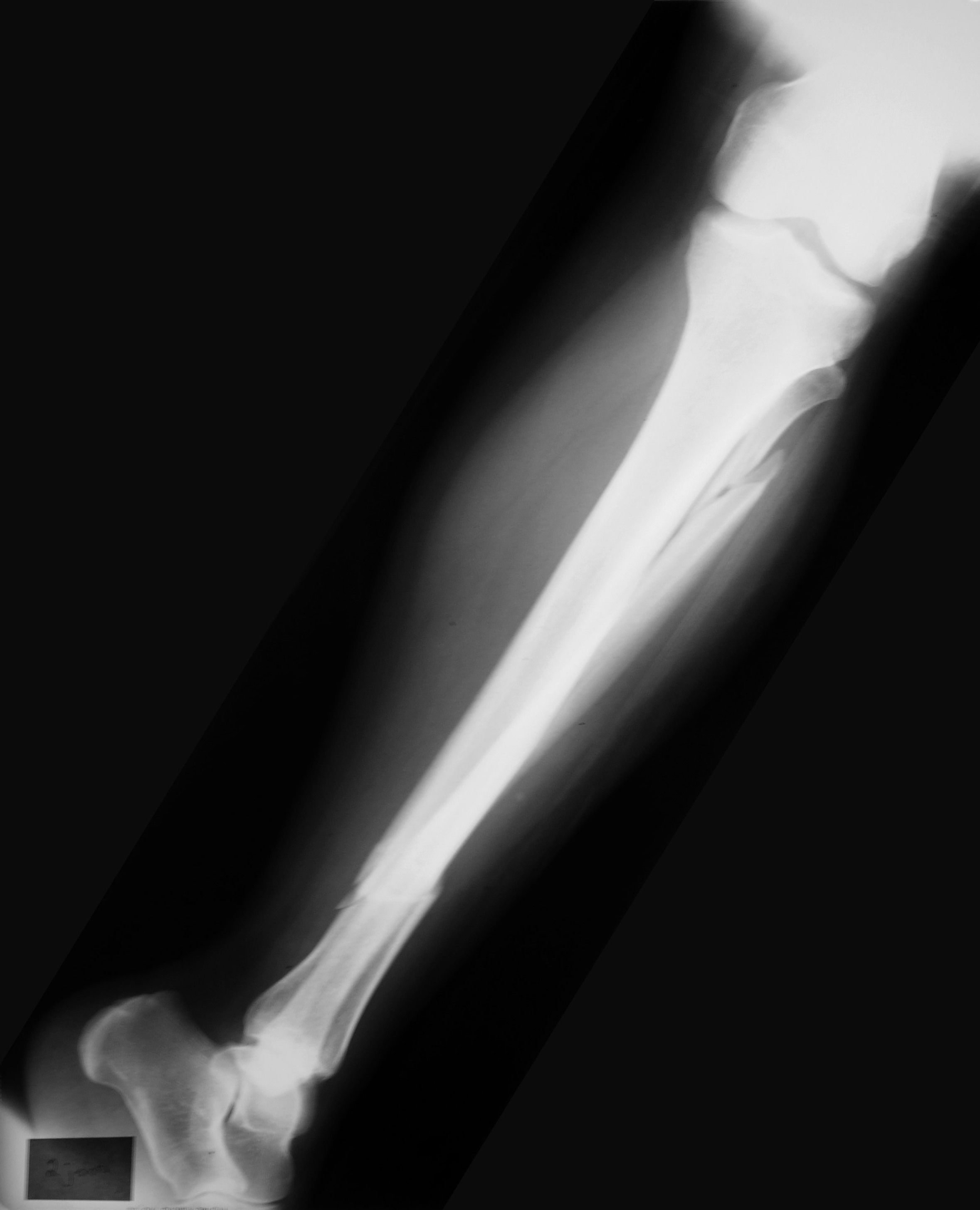 Трещина кости на ноге