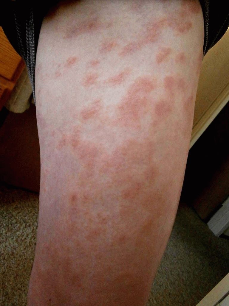 Варикозный дерматит нижних конечностей: симптомы и лечение