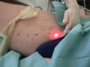 Лазерное лечение вен