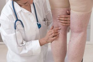 Варикозная болезнь ног